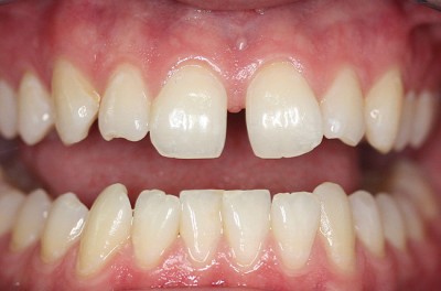 Диастема - щель между зубами, которая постепенно увеличивается