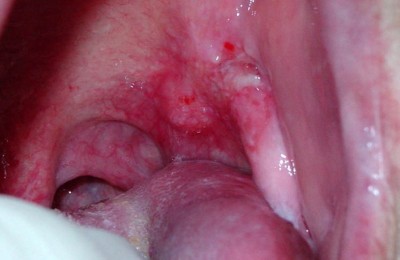 Лейкоплакия на внутренней стороне щек