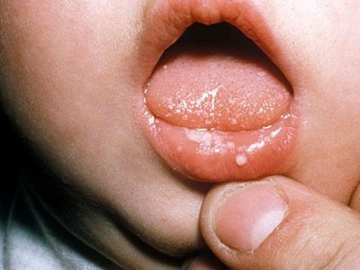 Стоматит у ребенка в полости рта